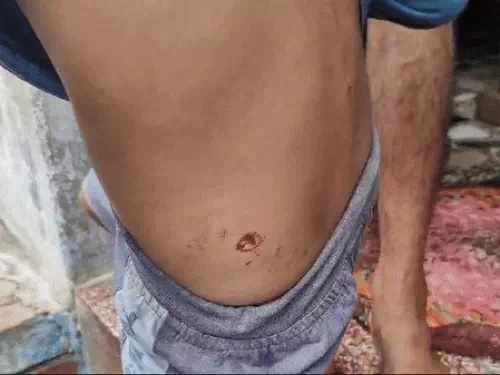 कुत्तों ने बच्ची के सिर, गर्दन, कमर और पैर पर 10 जगह नोच लिया कुत्तों ने बच्ची के सिर, गर्दन, कमर और पैर पर 10 जगह नोच लिया