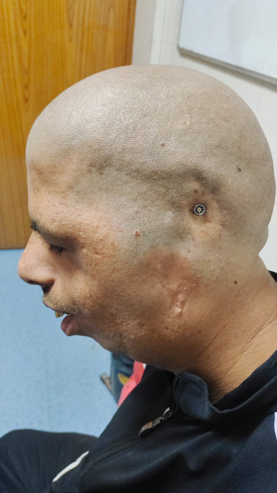 रेलवे के केंद्रीय अस्पताल में सफल ऑपरेशन के बाद उक्त टेक्नीशियन रेलवे के केंद्रीय अस्पताल में सफल ऑपरेशन के बाद उक्त टेक्नीशियन