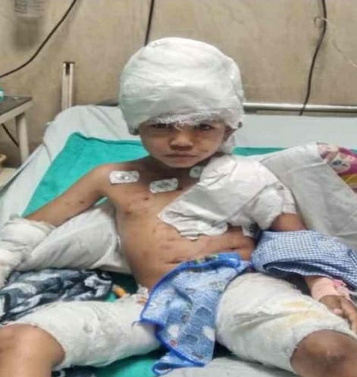 आवारा कुत्तों के हमले में घायल बासु कश्यप अस्पताल में उपचार कराते आवारा कुत्तों के हमले में घायल बासु कश्यप अस्पताल में उपचार कराते