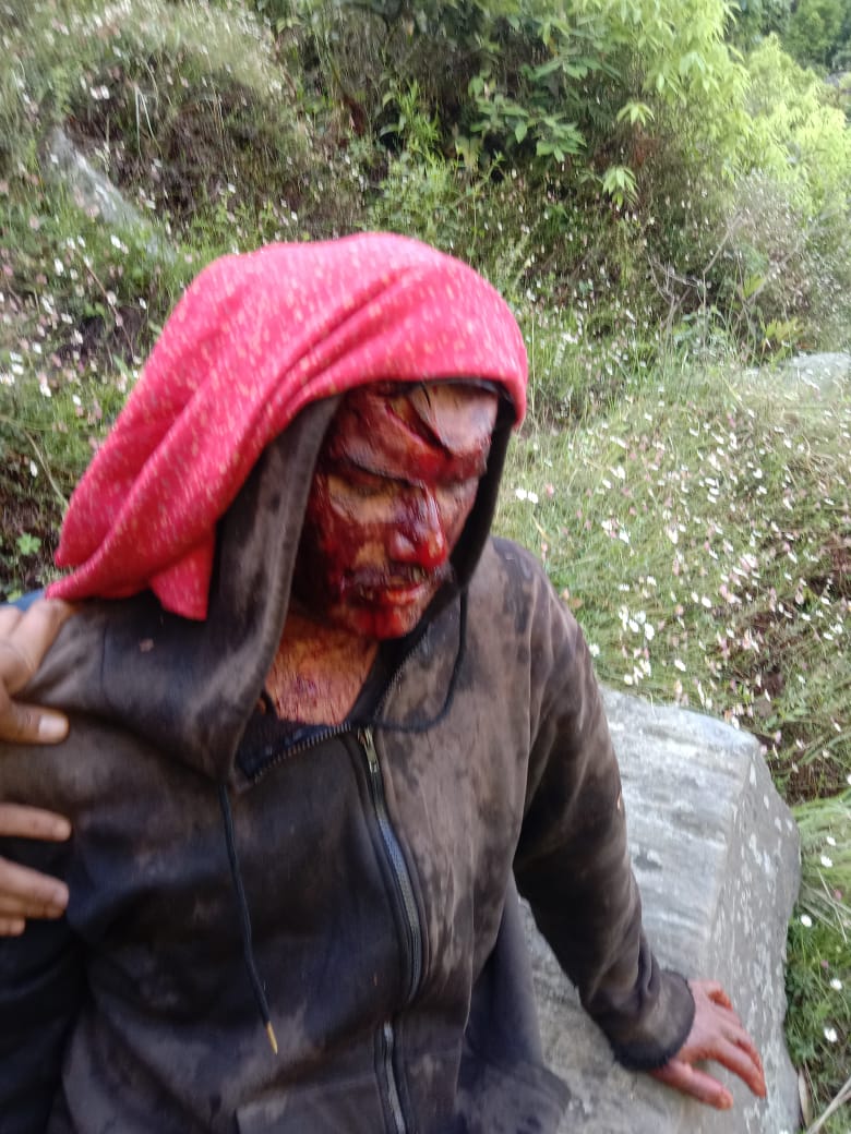 घंडूरी गांव में जंगली भालू का हमला, व्यक्ति गंभीर रूप से घायल घंडूरी गांव में जंगली भालू का हमला, व्यक्ति गंभीर रूप से घायल