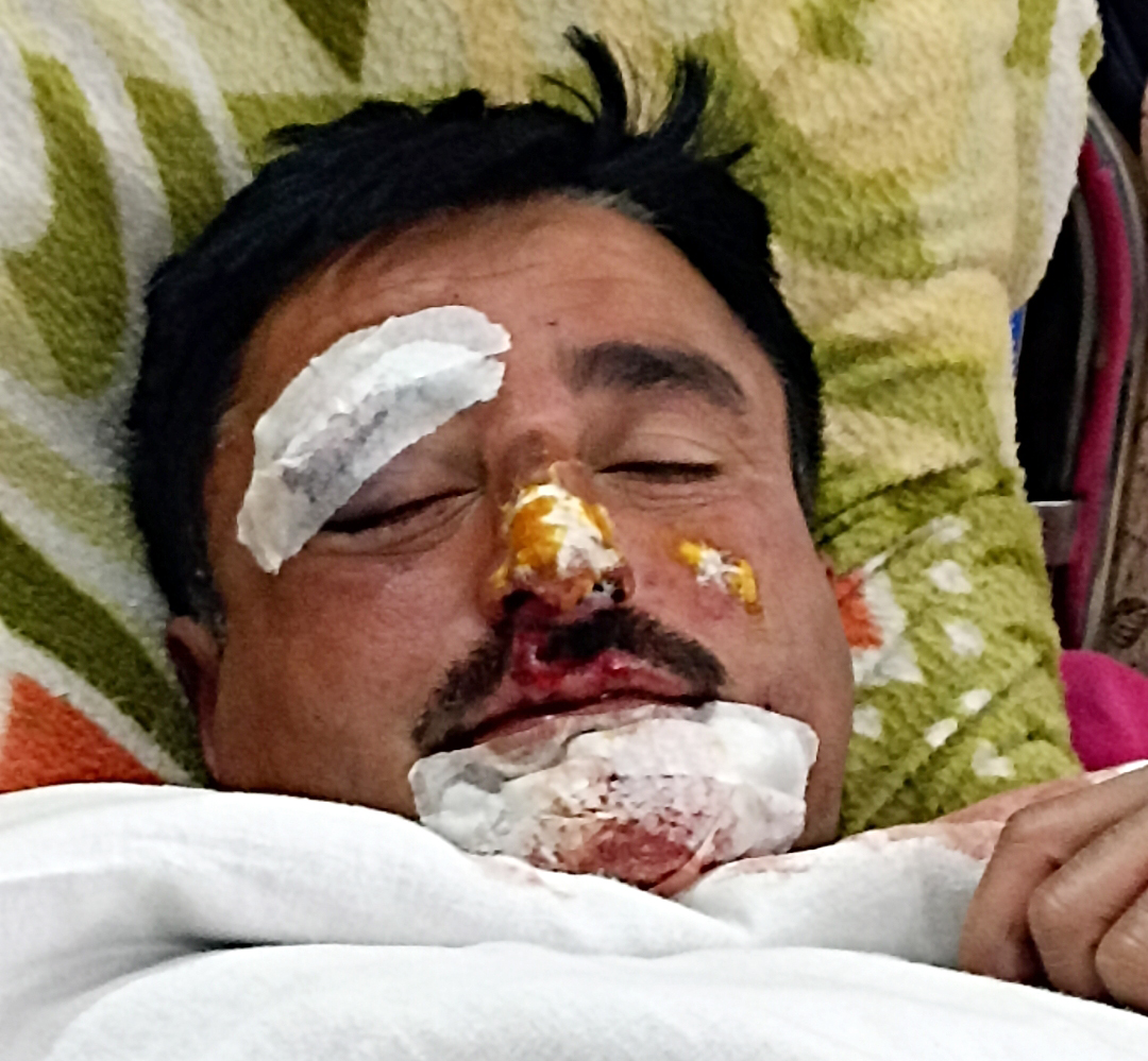 स्मैक तस्करी की सूचना पर पीछा कर रहे पुलिस कर्मी बाइक दुर्घटना में घायल स्मैक तस्करी की सूचना पर पीछा कर रहे पुलिस कर्मी बाइक दुर्घटना में घायल