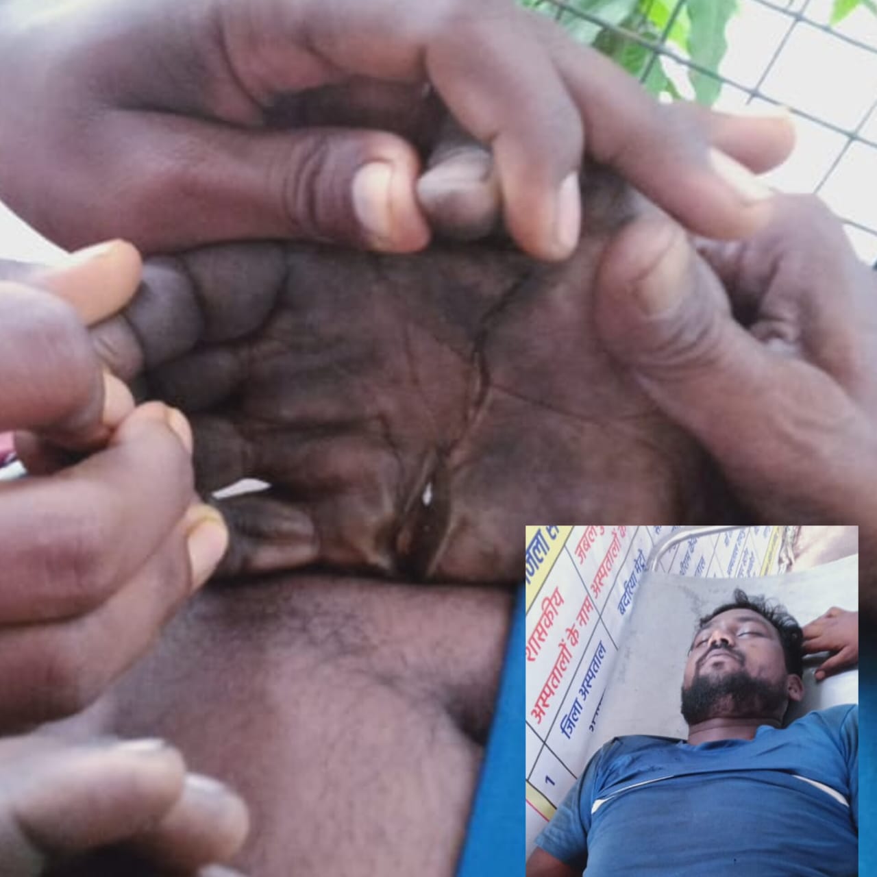 युवक के हाथ में लगा करेंट कटी हथेली युवक के हाथ में लगा करेंट कटी हथेली