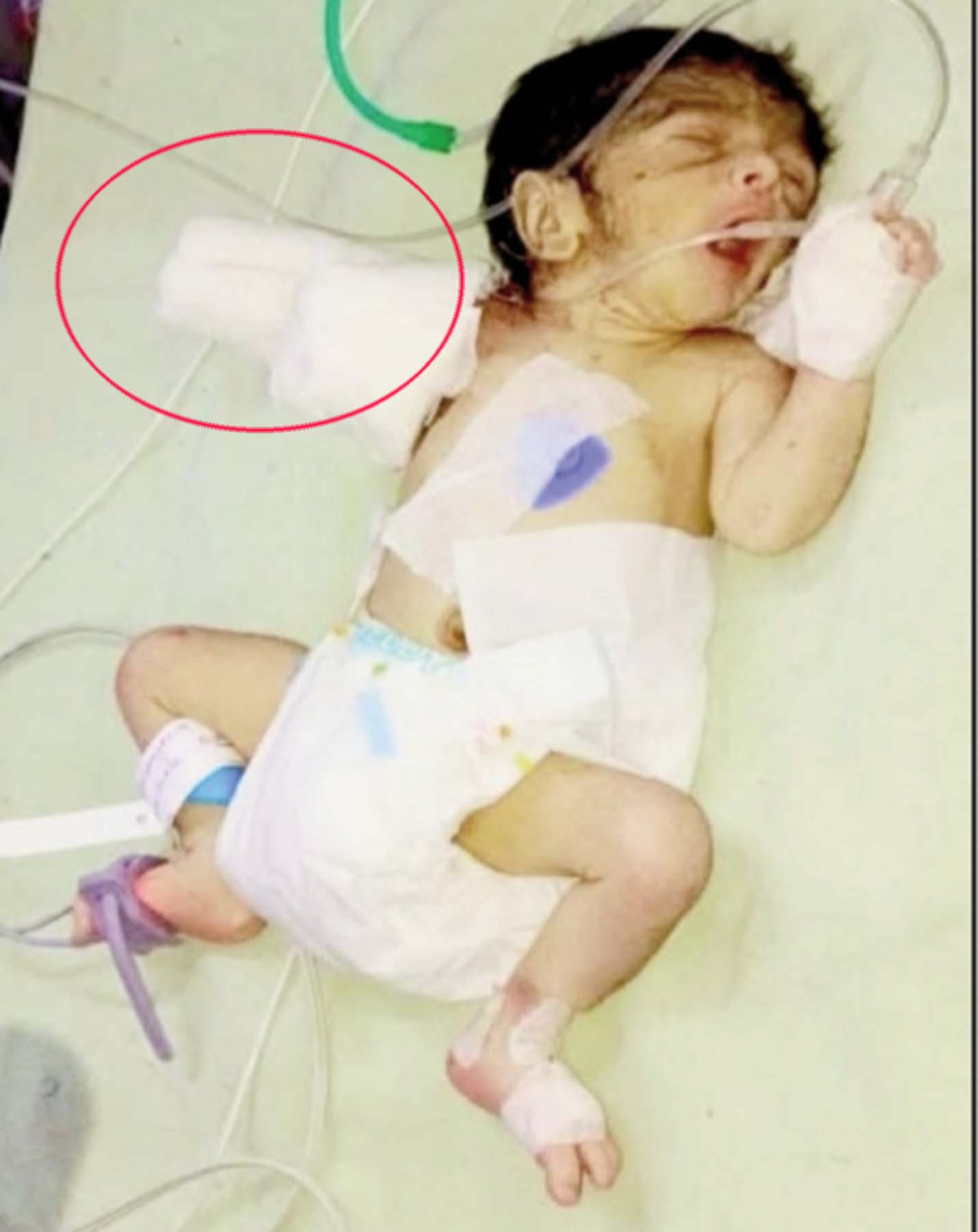 नूंह के मांडीखेड़ा अस्पताल में प्रसव के दौरान इसी बच्चे का कटा एक हाथ। नूंह के मांडीखेड़ा अस्पताल में प्रसव के दौरान इसी बच्चे का कटा एक हाथ।