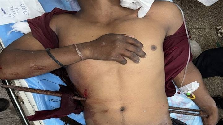 इंदौरः एमवाय में युवक के शरीर में लोहे के सरिए निकालने के लिए जटिल सर्जरी सफल इंदौरः एमवाय में युवक के शरीर में लोहे के सरिए निकालने के लिए जटिल सर्जरी सफल