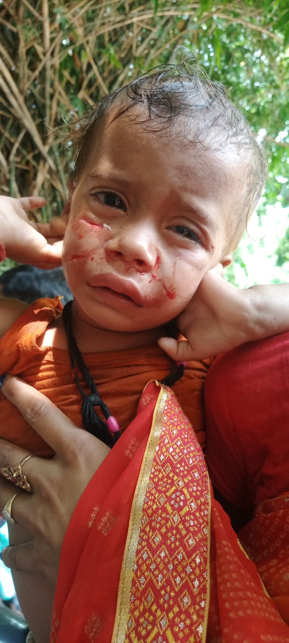 घायल बच्चा