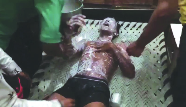 तेजाब फेंकने से पीडि़त युवक तेजाब फेंकने से पीडि़त युवक