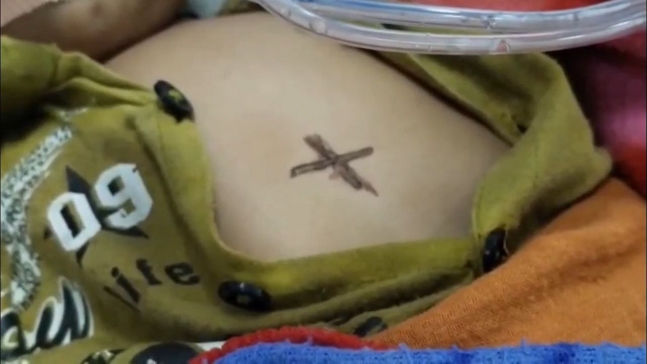 अंधविश्वास बना मासूम की मौत का कारण भोपा ने गर्म सरिए से दागा, तीन दिन वेंटिलेटर पर रहने के बाद तोड़ा दम