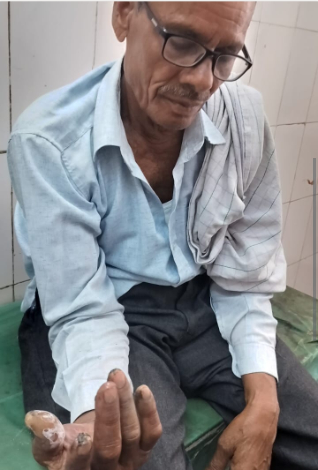 फोटो झूलसे लोग फोटो झूलसे लोग